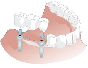 Implantatgetragener Zahnersatz für mehrere Zähne nebeneinander.