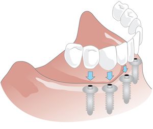 Implantatgestützte Prothesen sind mit dem Kiefer fest verbunden.