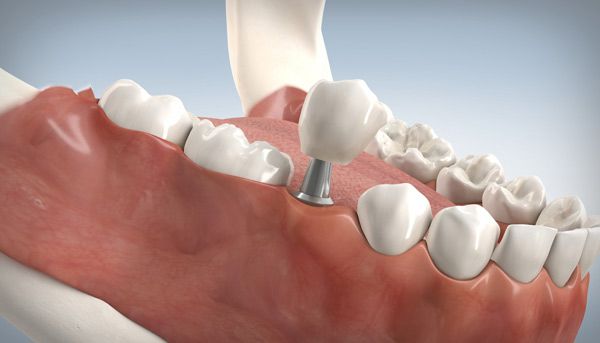 Eine 3D-Implantatplanung kann die Position und Größe der Implantete planen.