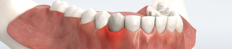 Parodontologie-Behandlung für gesundes Zahnfleisch.