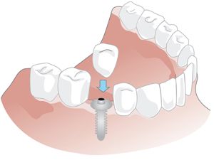 Ersatz eines Einzelzahns mithilfe eines Implantats.