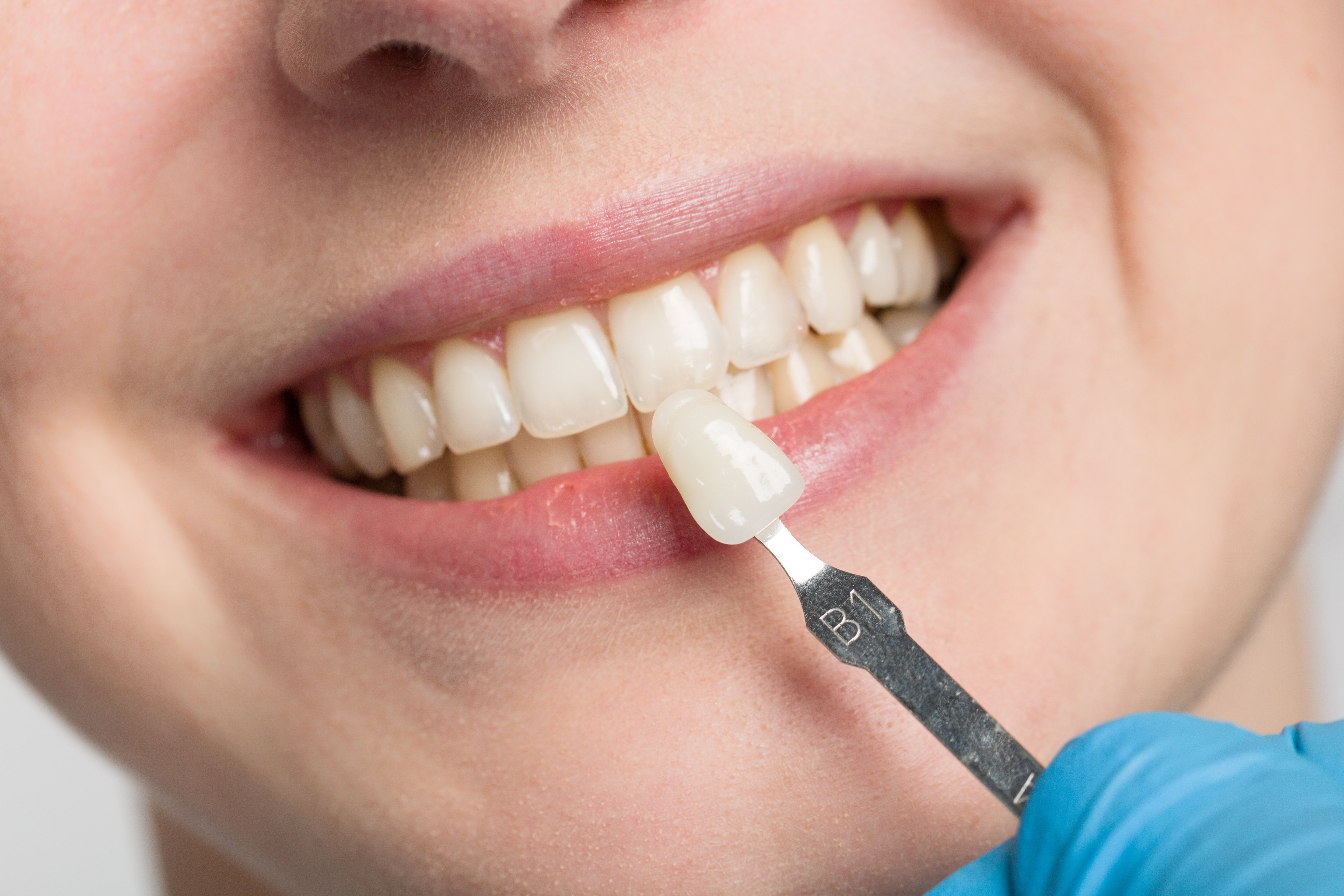 Veneers und Verblendschalen beseitigen kleinere ästhetische Mängel an den Zähnen.