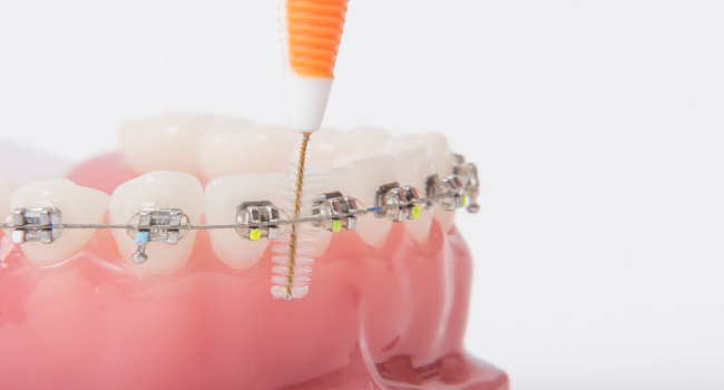 Feste Zahnspange mit Interdentalbürstchen