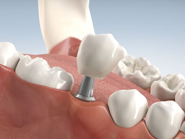 Hochwertige Implantate bei Dr. Winking in Bochum.